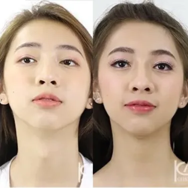 Удаление Адамового яблока