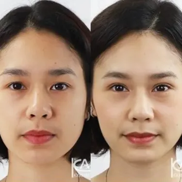 Блефаропластика