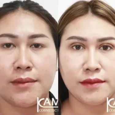 Блефаропластика