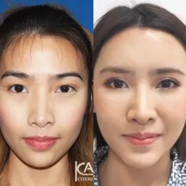 Блефаропластика