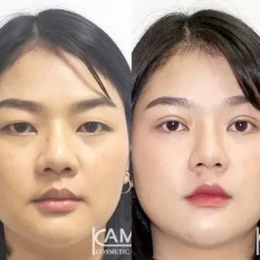 Блефаропластика