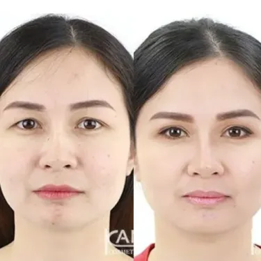 Блефаропластика