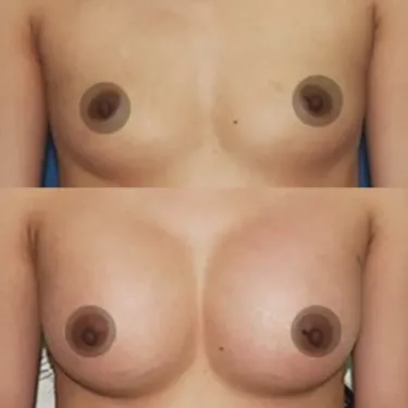 Breast augmentation