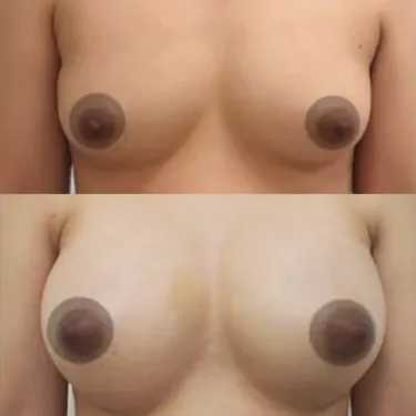 Breast augmentation