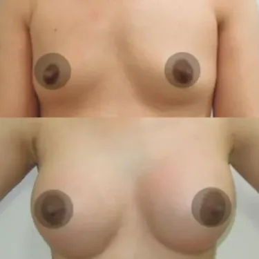 Breast augmentation
