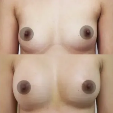 Breast augmentation