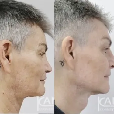 Facial Masculinization Surgery (FMS)