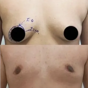 Mastectomy