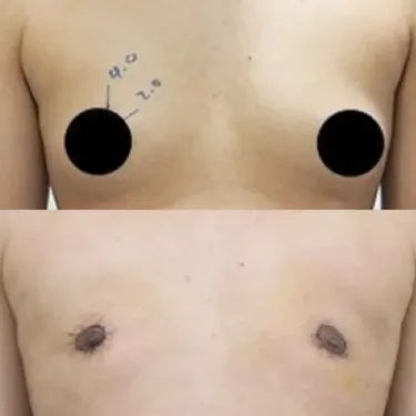 Mastectomy