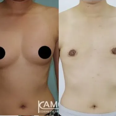 Mastectomy