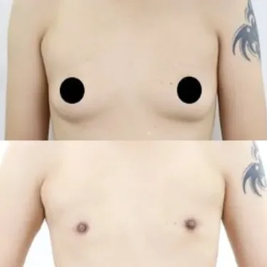 Mastectomy