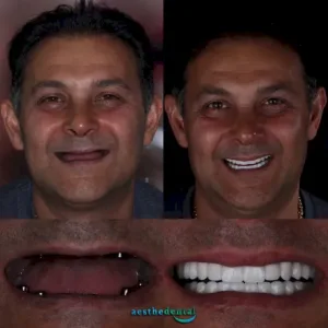 dental implants in Istanbul