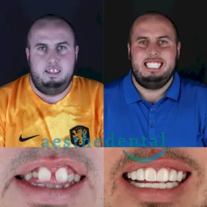 dental implants in Turkey