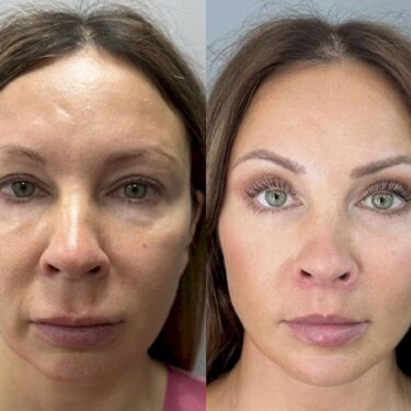 Endolift