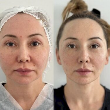 Endolift
