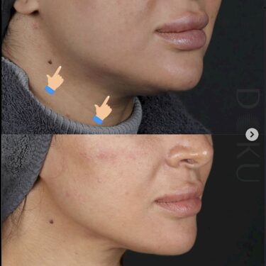 Endolift