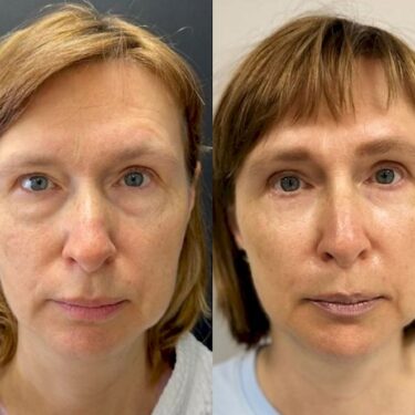 Endolift