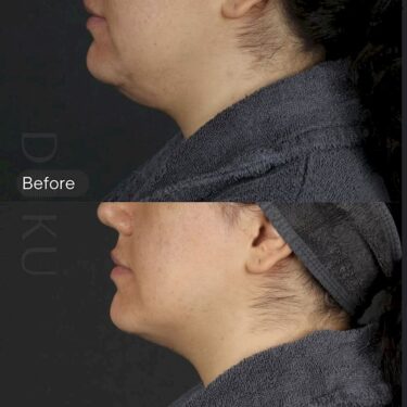 Endolift