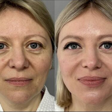 Endolift