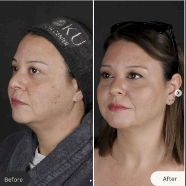 Endolift