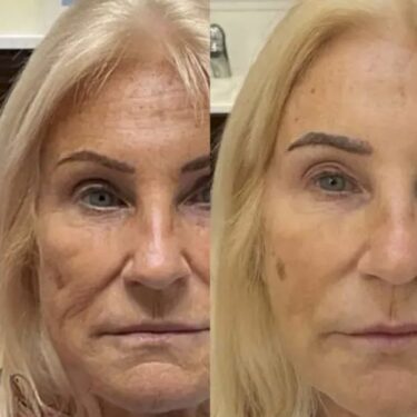Endolift