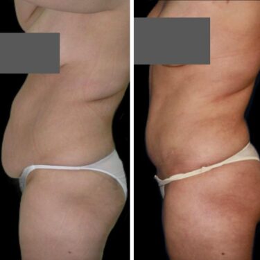 Липосакция