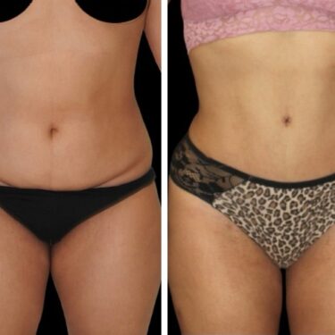 Липосакция