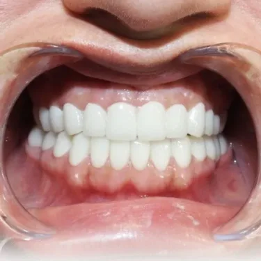 Имплантация зубов