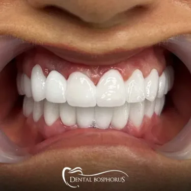 Имплантация зубов