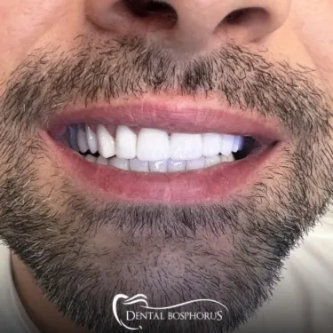 Имплантация зубов