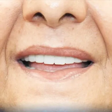 Имплантация зубов