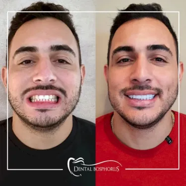 Голливудская улыбка