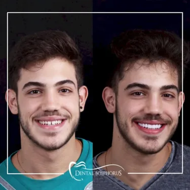 Голливудская улыбка