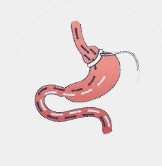 Gastric banding   