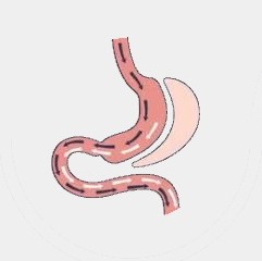 Sleeve gastrectomy   
