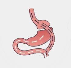 Gastric bypass   