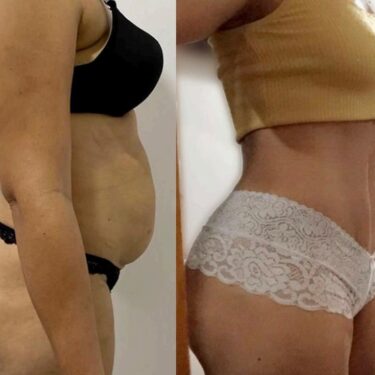 Fettabsaugung und Abdominoplastik