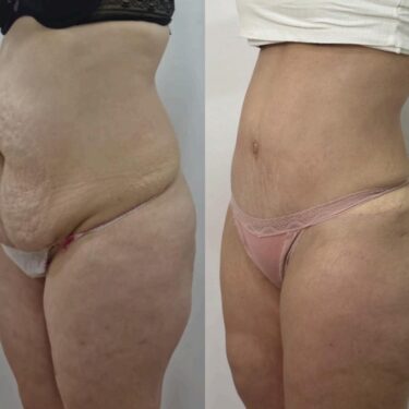 Fettabsaugung und Abdominoplastik