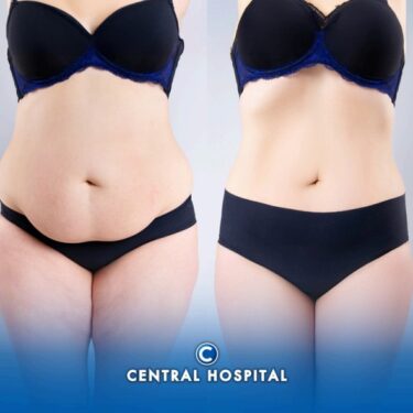 Fettabsaugung und Abdominoplastik