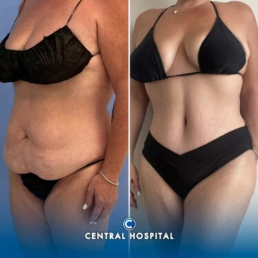 Fettabsaugung und Abdominoplastik