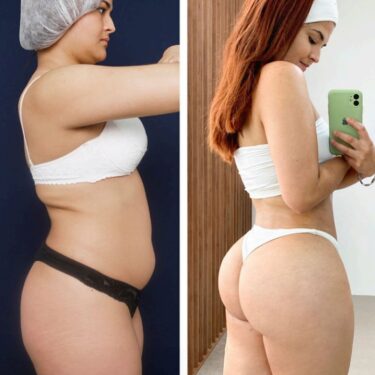 Brazilian Butt Lift