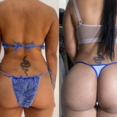 Brazilian Butt Lift