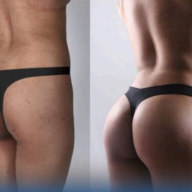 Brazilian Butt Lift