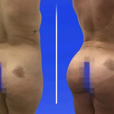 Brazilian Butt Lift