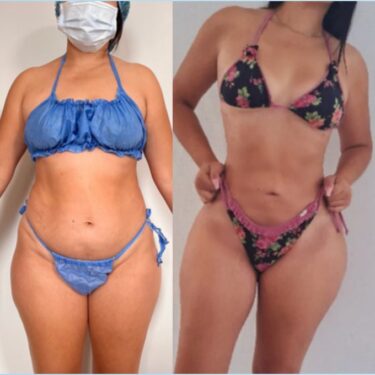 Fettabsaugung und Abdominoplastik