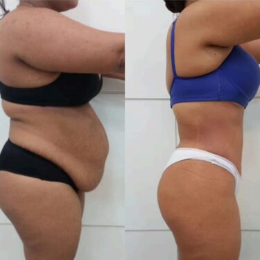 Fettabsaugung und Abdominoplastik