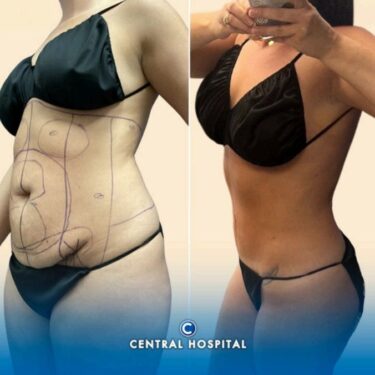 Fettabsaugung und Abdominoplastik