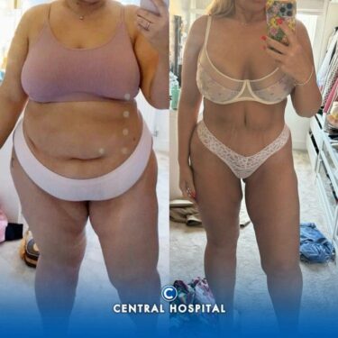 Fettabsaugung und Abdominoplastik