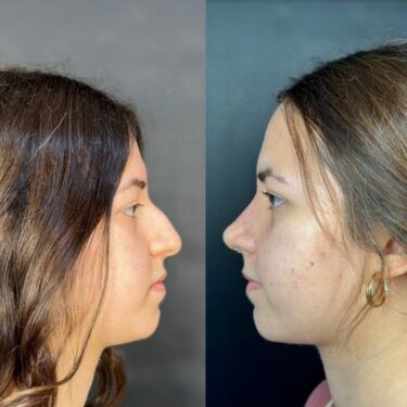 Rhinoplastik