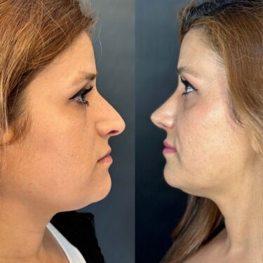 Rhinoplastik